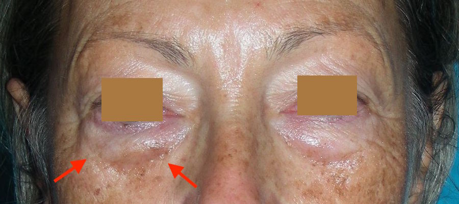 Poches sous les yeux - Gonflement des paupières inférieures